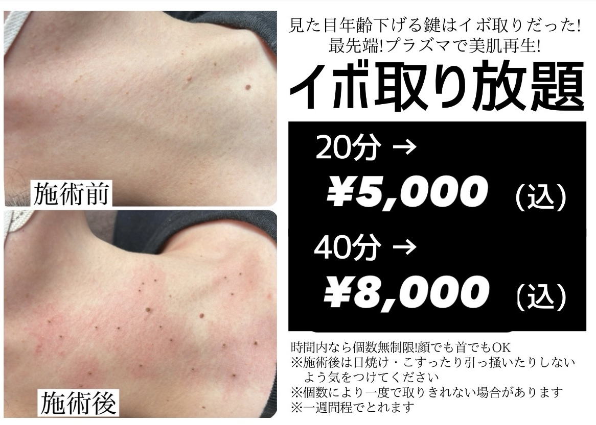 イボ取り放題